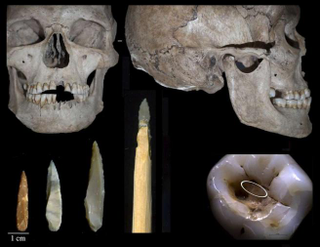 Illustration for article titled Hallan la 1ª prueba de intervenciones dentales hace 14.000 años